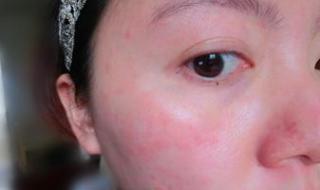 全国花粉过敏预警地图